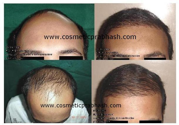 Hair Transplant