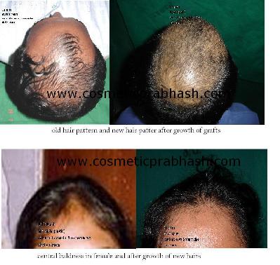 Hair Transplant Density and hair transplantation in female or women