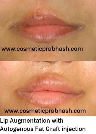 Lip Enlargement Fat Grafting India Lip Enhancement Delhi