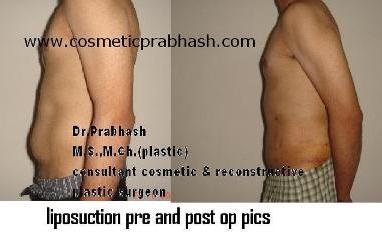 Liposuction Delhi Best Fat Removal Body Reshaping Cost India.
