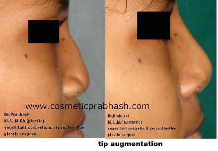 Rhinoplasty in India Befoer after by Dr Prabhash Delhi