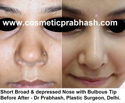 Best Rhinoplasty in India - Augmentation Nose Surgery in Delhi Using bone graft by Dr Prabhash, best rhinoplasty surgeon.