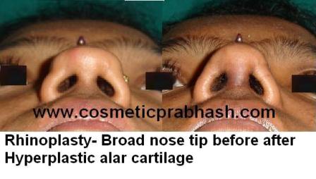 best Rhinoplasty in India Flat broad nose tip correction before after Delhi
