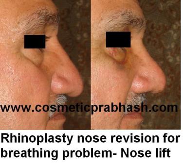Best Rhinoplasty in Delhi Droopy tip correction India.