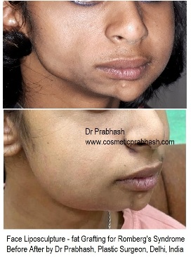 Romberg's Syndrome Face Cheek Under Eye fat transfer grafting before after delhi india-2