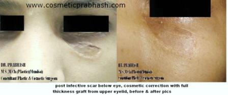 Scar Removal India Skin Grafting Delhi NCR