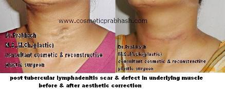 Scar Removal Treatment Delhi NCR India