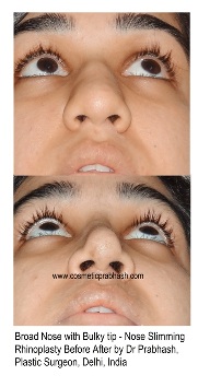 Rhinoplasty Before After wide Nose, India, Delhi 1