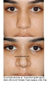 Rhinoplasty Before After in India, Delhi 2 best plastic surgeon