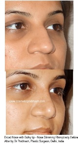 Rhinoplasty before after , India, Delhi, best rhinoplasty cost 2