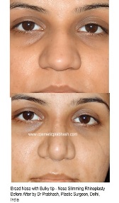 Rhinoplasty before after , India, Delhi, best rhinoplasty cost 