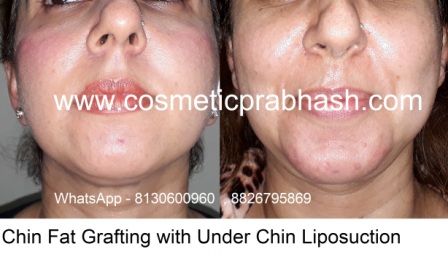 Chin enlargement India chin fat grafting Delhi 1