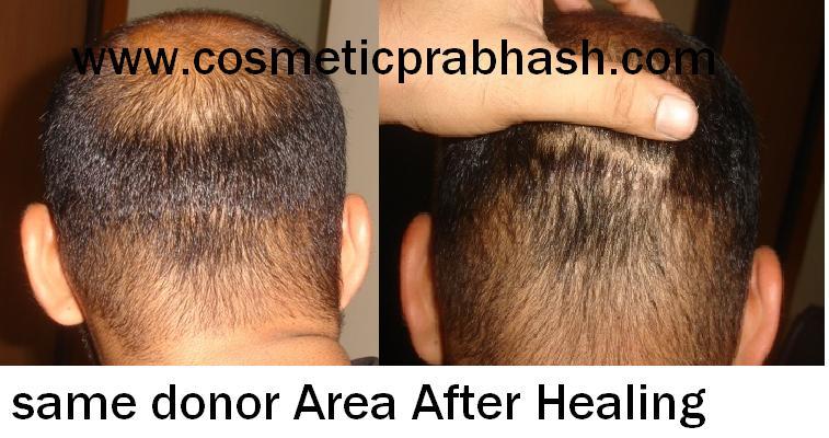 Hair transplant picture 2