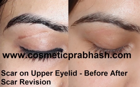 face scar removal delhi Eyelid scar treatment India dr Prabhash