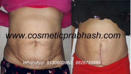 tummy tuck in Delhi Dr Prabhash India